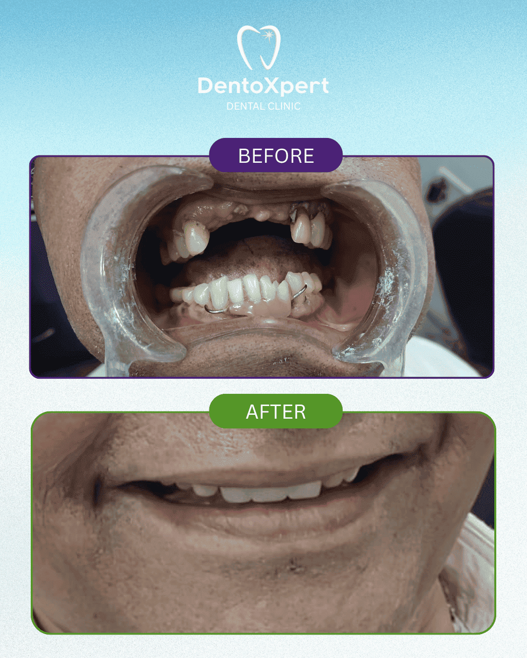 Before and after dental treatment result at DentoXpert Dental Clinic in Thane
